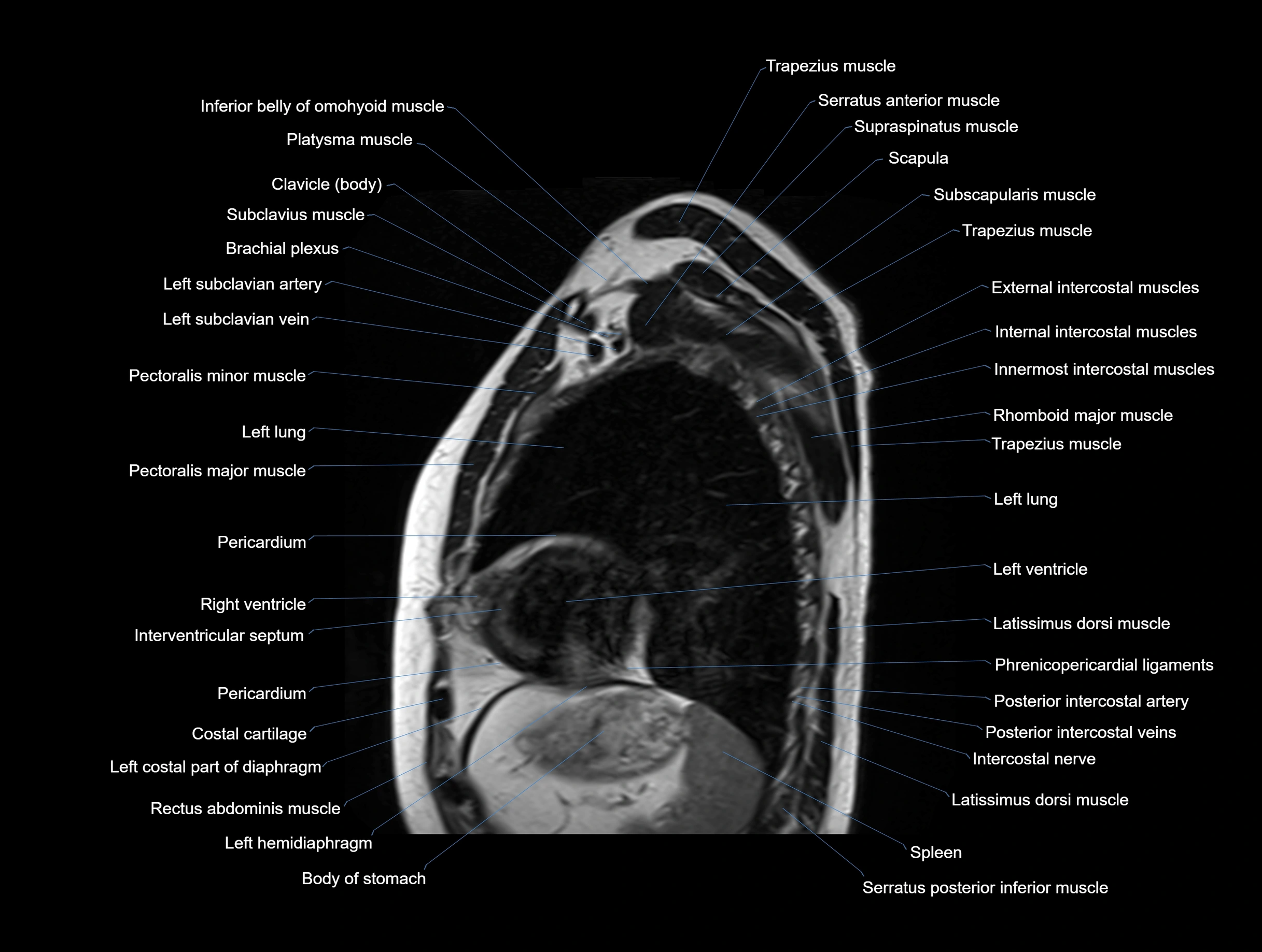 MRI chest (thorax) coronal  cross sectional anatomy 3T radiology  image-img-00001-00029.webp